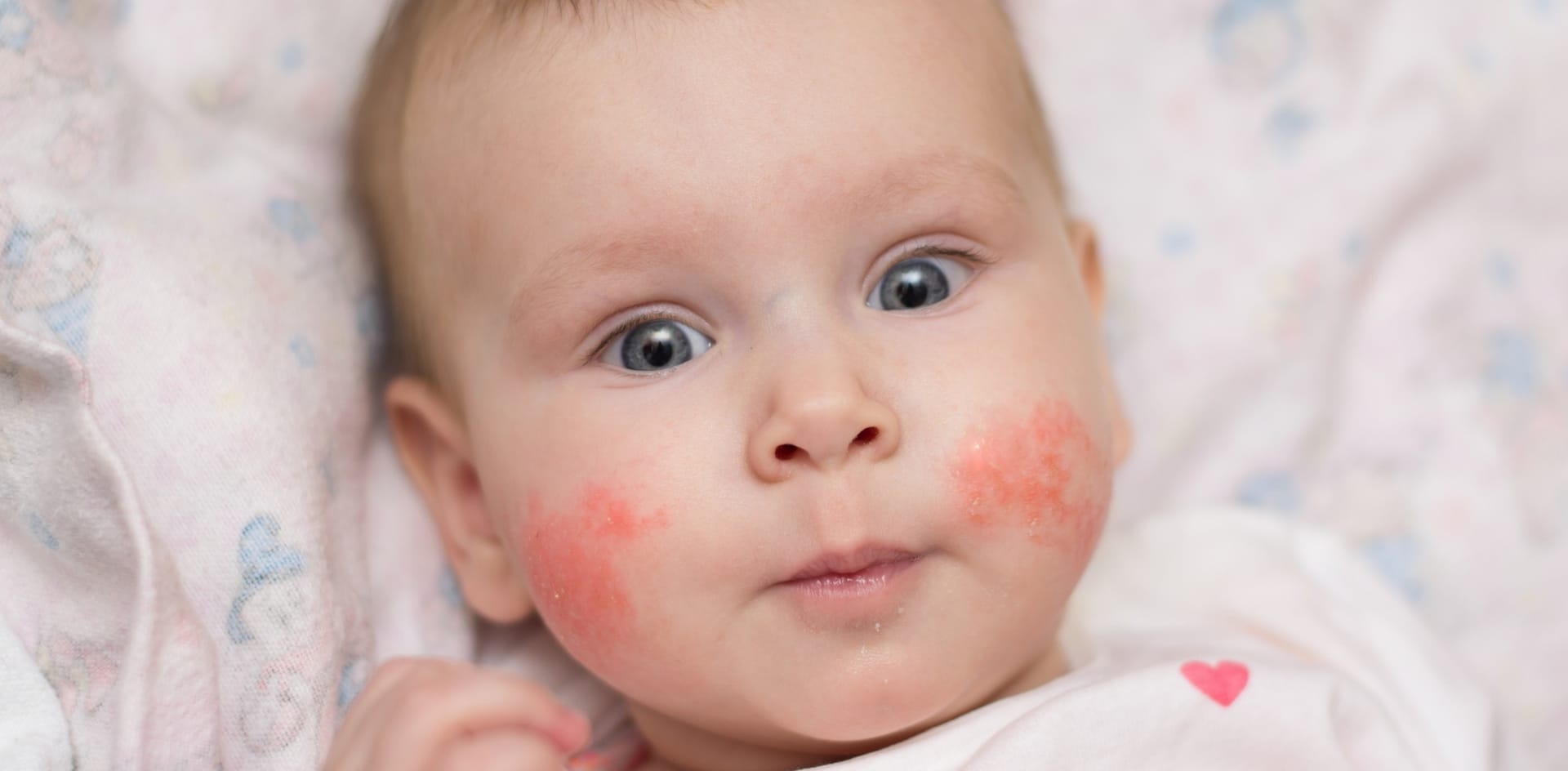 Neurodermitis bei Babys: Symptome und Behandlung
