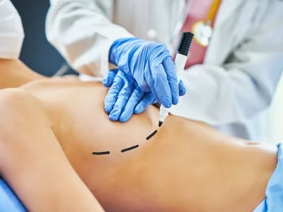 Brustvergrößerung mit Straffung: So unterstützen wir Ihren Wunsch nach Veränderung