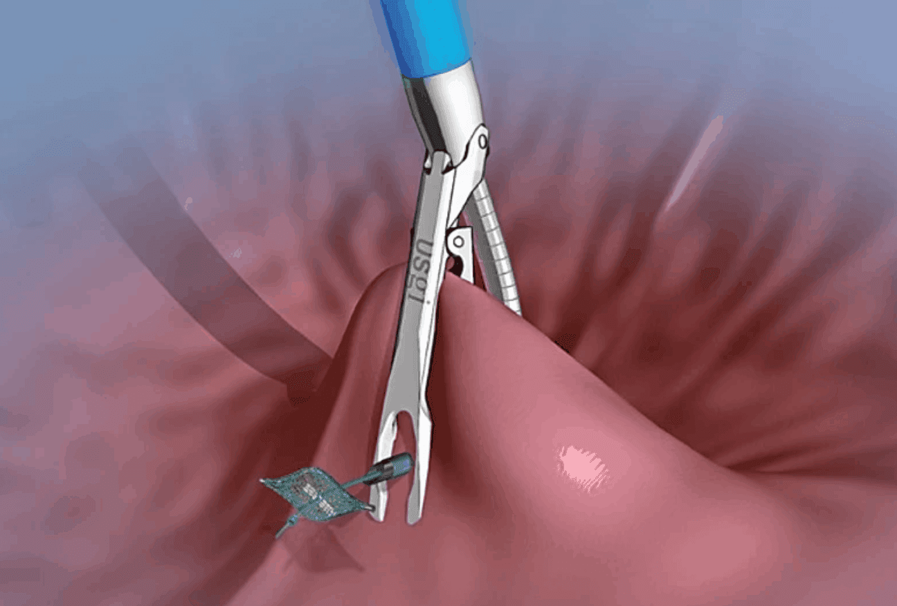 Magenverkleinerung Türkei: Entdecken Sie die beste Klinik für sichere Gewichtsabnahme