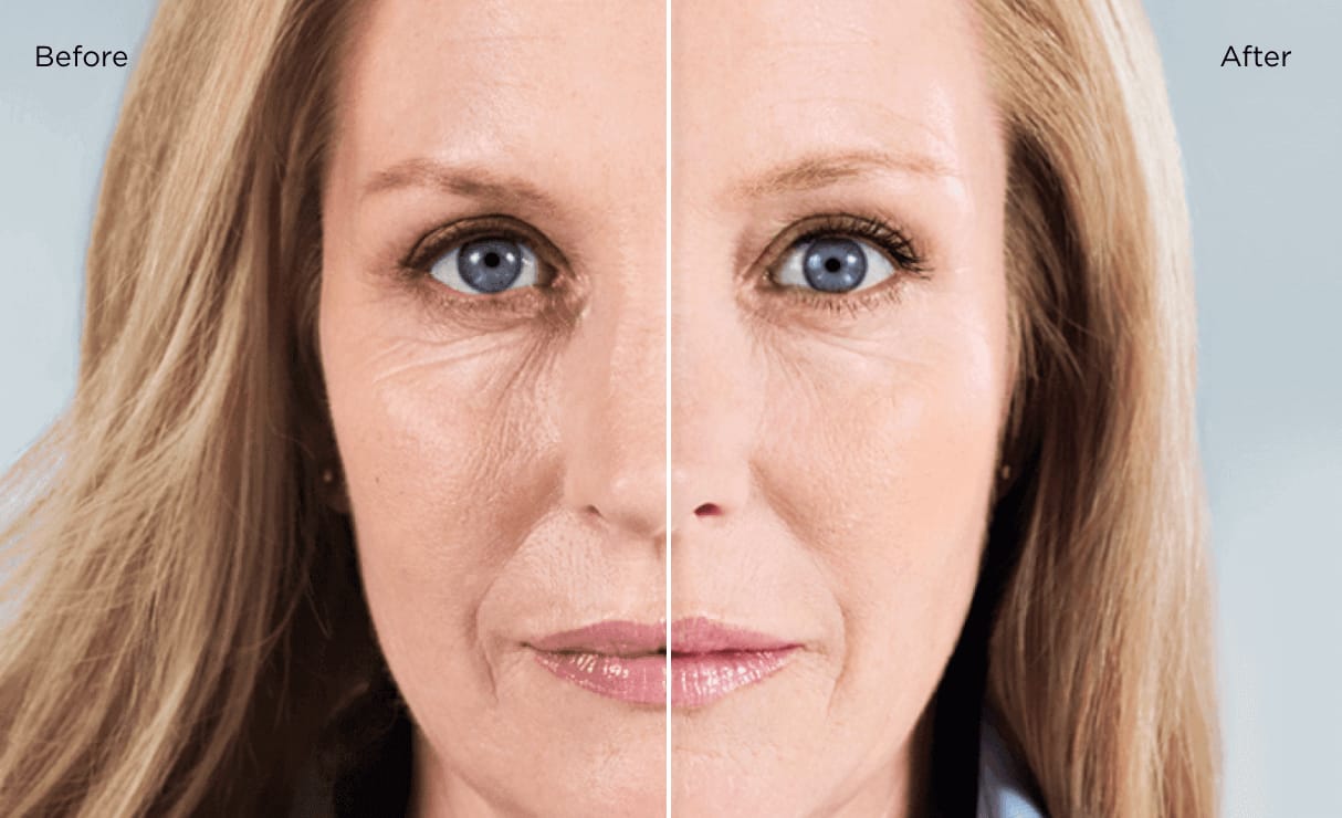 Sculptra: Natürliche Kollagenstimulation für straffere Haut und langanhaltende Verjüngungseffekte