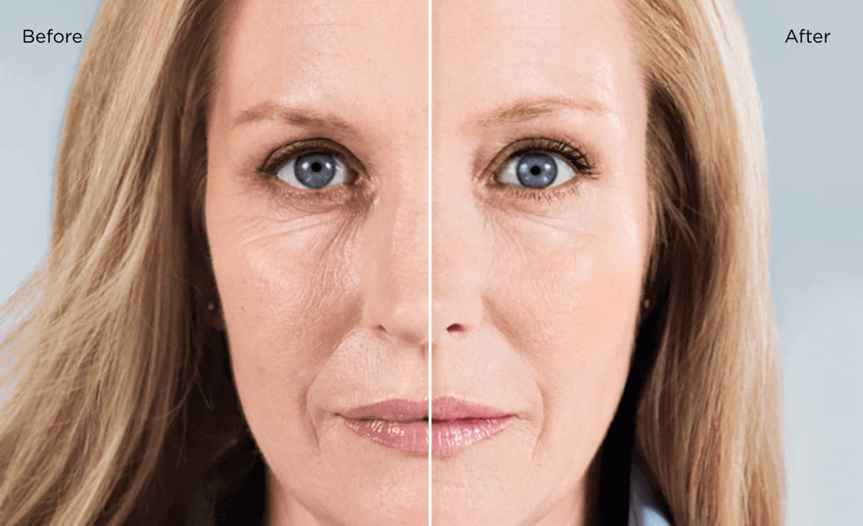Sculptra: Natürliche Kollagenstimulation für straffere Haut und langanhaltende Verjüngungseffekte